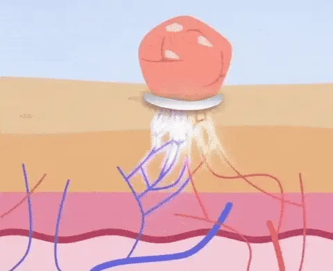 DermaPlus Kit - Removedor de Verrugas e Marcas da Pele