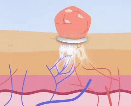 DermaPlus Kit - Removedor de Verrugas e Marcas da Pele