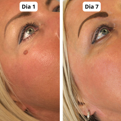 DermaPlus Kit - Removedor de Verrugas e Marcas da Pele