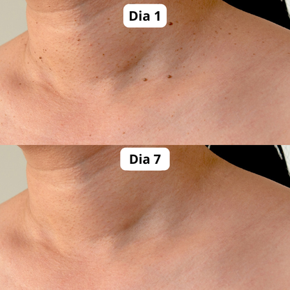 DermaPlus Kit - Removedor de Verrugas e Marcas da Pele